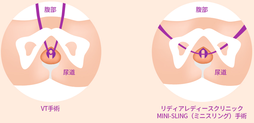 TVT 수술 vs 리디아 여성의원 MINI-SLING 수술 비교