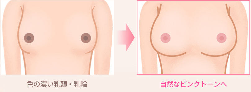 根据每个人乳头状态、皮肤弹性等诊断结果进行激光治疗，术后即可拥有明亮粉嫩的乳头与乳晕色泽。